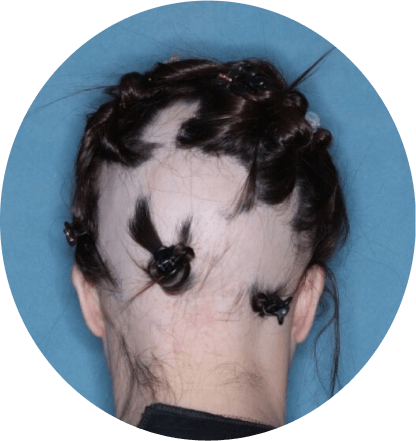back of head of patient showing scalp hair coverage taken before treatment with olumiant 2mg once daily