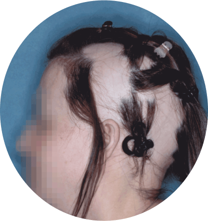 left side profile of patient showing scalp hair coverage taken before treatment with olumiant 2mg once daily