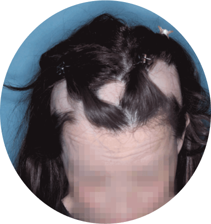 top of head of patient showing scalp hair coverage taken before treatment with olumiant 2mg once daily