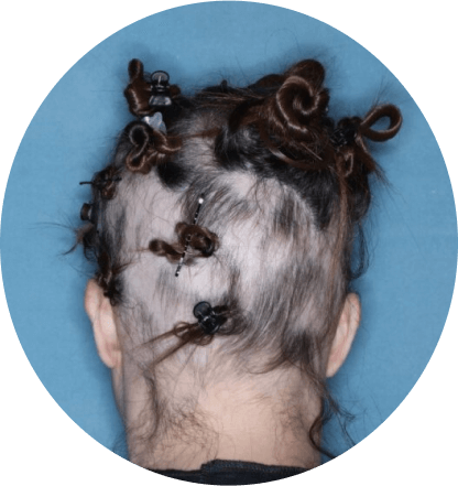 back of head of patient showing scalp hair coverage taken at 12 weeks with olumiant 2mg once daily