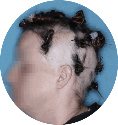 left side profile of patient showing scalp hair coverage taken at 12 weeks with olumiant 2mg once daily