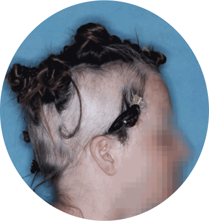 right profile of patient showing scalp hair coverage taken at 12 weeks with olumiant 2mg once daily