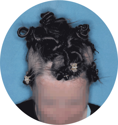 top of head of patient showing scalp hair coverage taken at 12 weeks with olumiant 2mg once daily