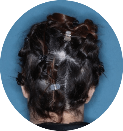 back of head of patient showing scalp hair coverage taken at 36 weeks with olumiant 2mg once daily