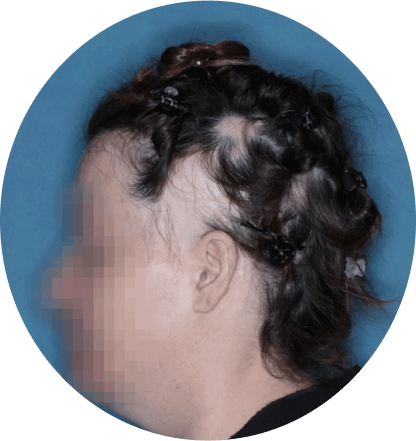 left side profile of patient showing scalp hair coverage taken at 36 weeks with olumiant 2mg once daily