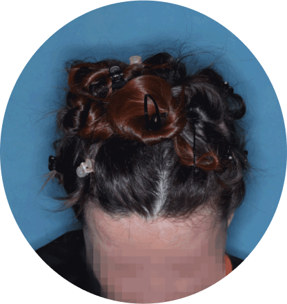 top of head of patient showing scalp hair coverage taken at 36 weeks with olumiant 2mg once daily