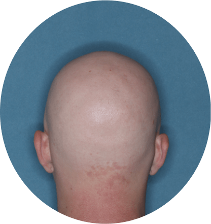 back of head of patient showing scalp hair coverage taken before treatment with Olumiant 4 mg once daily