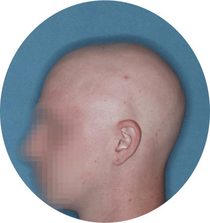 left side profile of patient showing scalp hair coverage taken before treatment with Olumiant 4 mg once daily