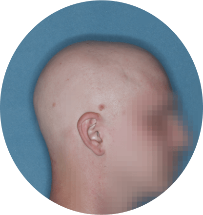right profile of patient showing scalp hair coverage taken before treatment with Olumiant 4 mg once daily