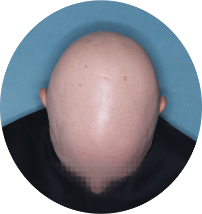 top of head of patient showing scalp hair coverage taken before treatment with Olumiant 4 mg once daily