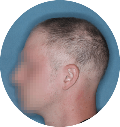 left side profile of patient showing scalp hair coverage taken at 12 weeks with Olumiant 4 mg once daily