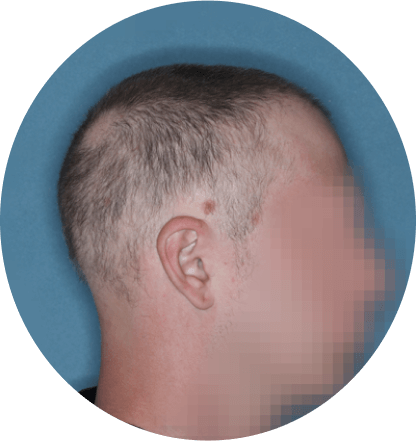 right profile of patient showing scalp hair coverage taken at 12 weeks with Olumiant 4 mg once daily