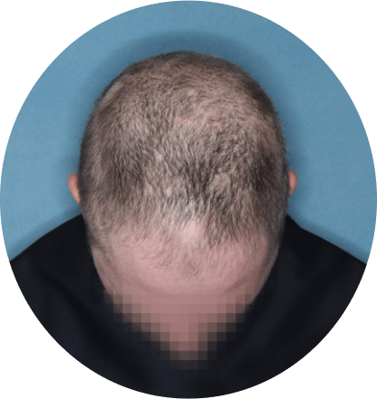top of head of patient showing scalp hair coverage taken at 12 weeks with Olumiant 4 mg once daily
