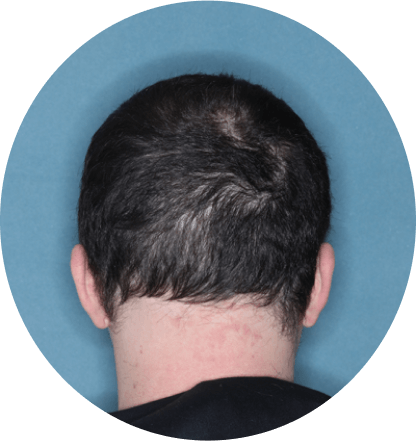 back of head of patient showing scalp hair coverage taken at 36 weeks with Olumiant 4 mg once daily