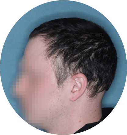 left side profile of patient showing scalp hair coverage taken at 36 weeks with Olumiant 4 mg once daily