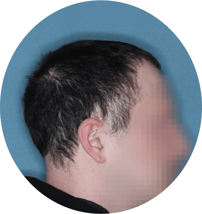 right profile of patient showing scalp hair coverage taken at 36 weeks with Olumiant 4 mg once daily