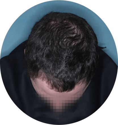 top of head of patient showing scalp hair coverage taken at 36 weeks with Olumiant 4 mg once daily