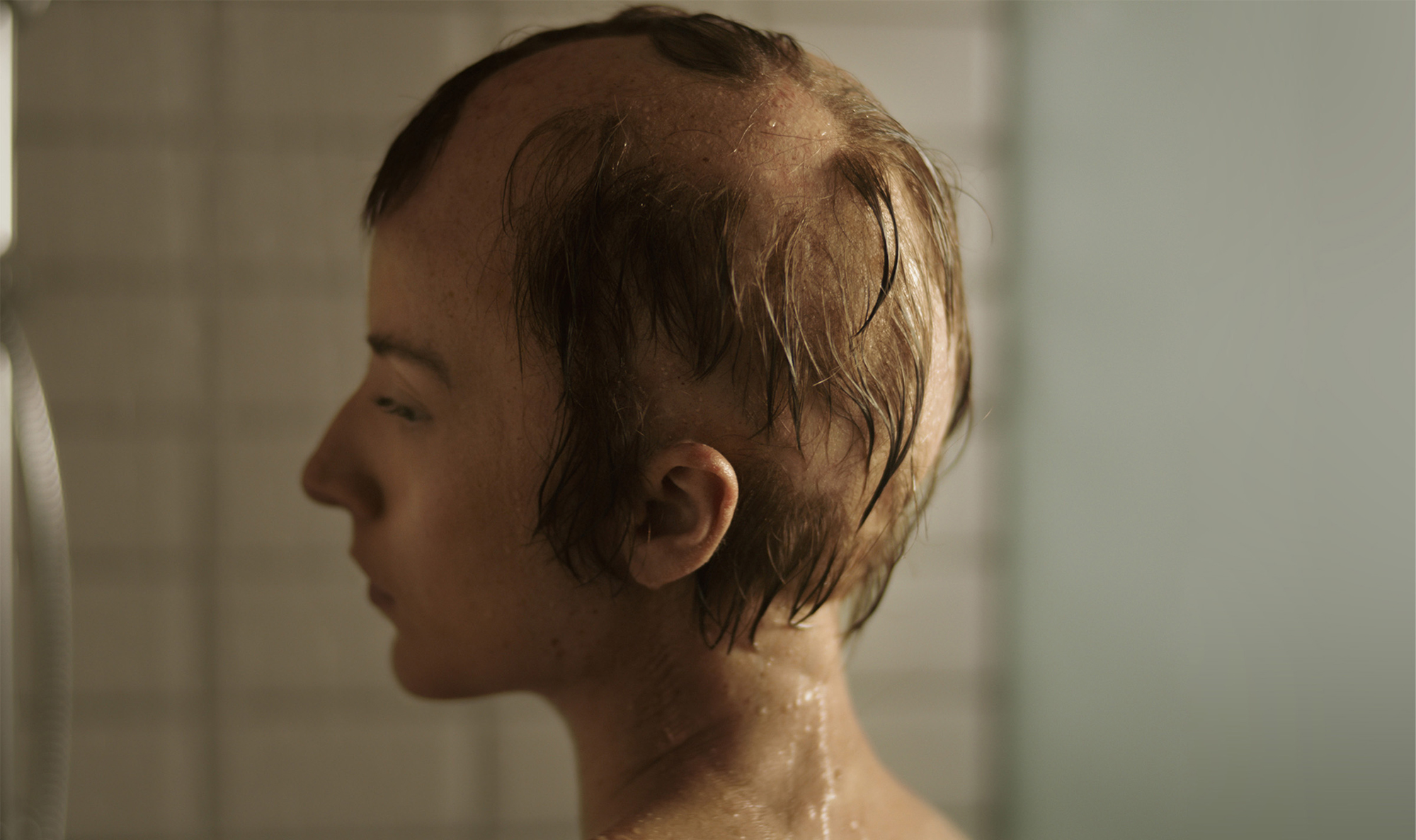 alopecia areata patient after treatment