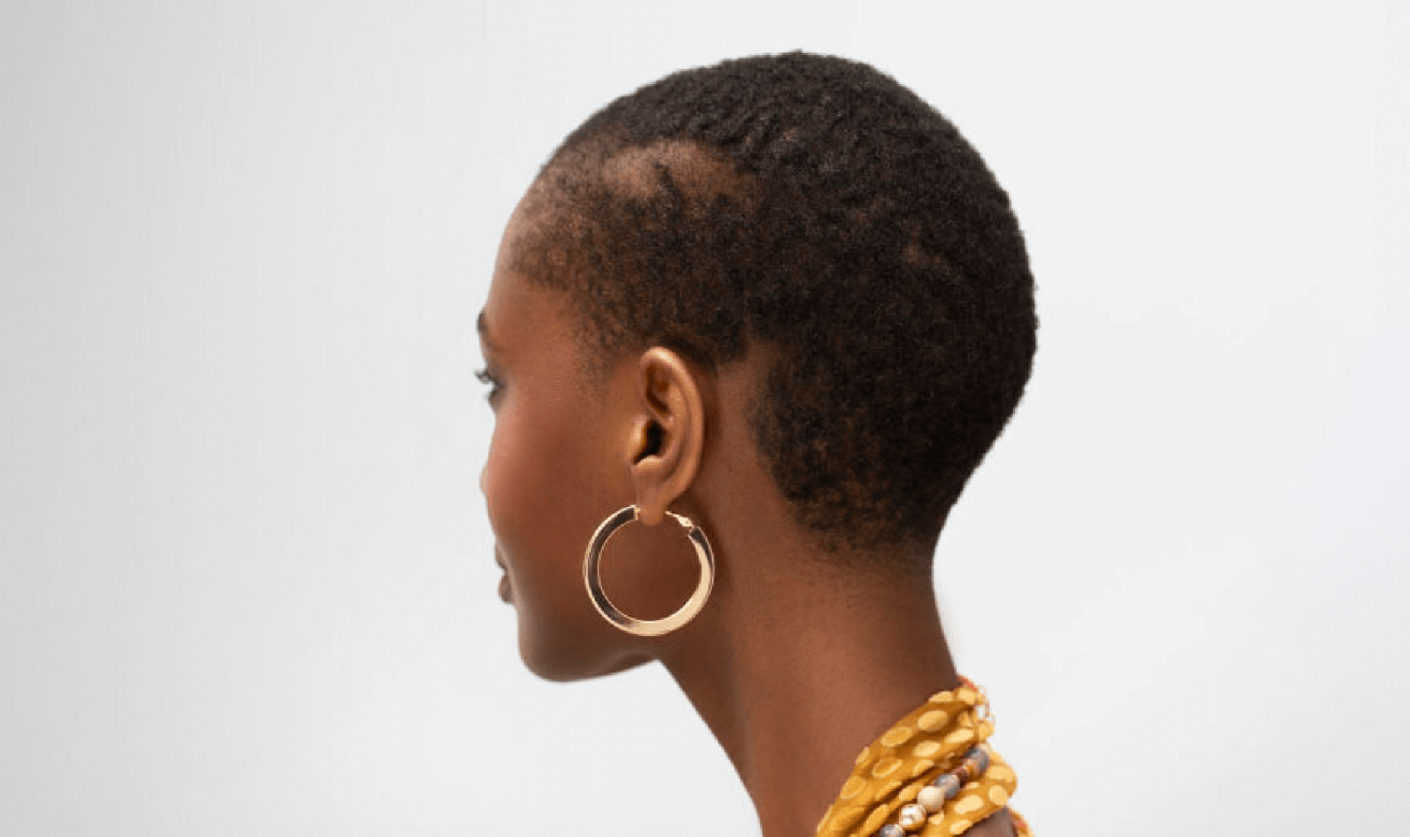 alopecia areata patient before treatment