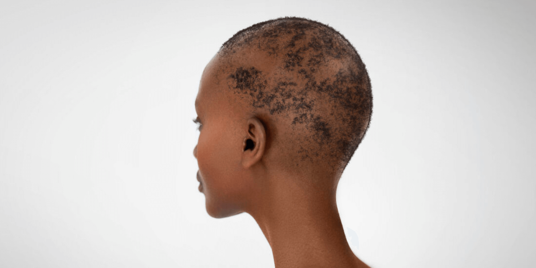 alopecia areata patient after treatment