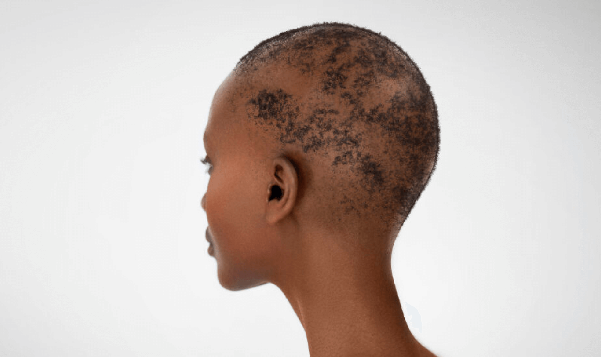 alopecia areata patient after treatment