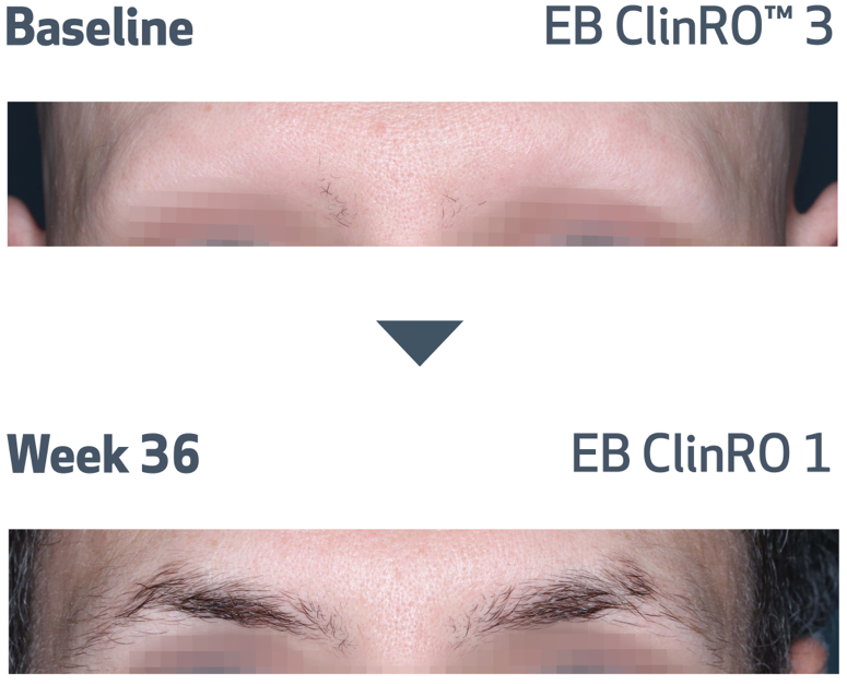 Eyebrow photos of alopecia areata patient at baseline and at week 36