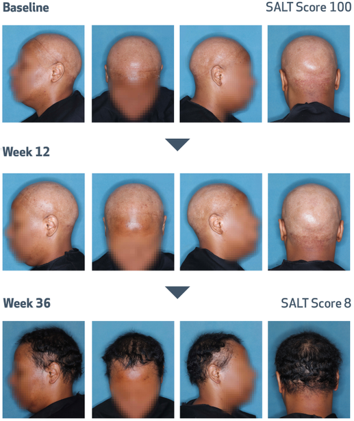 Scalp photos of alopecia areata patient at baseline and at week 36