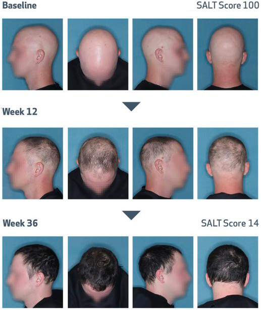 Scalp photos of alopecia areata patient at baseline and at week 36